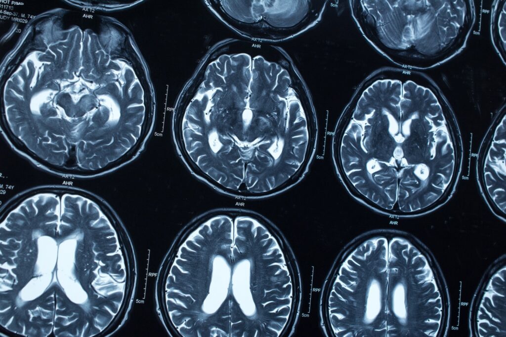 Scientists Discover High Levels of Aluminum in Brains of Deceased Autistic Individuals