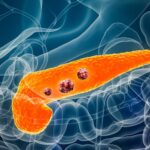 10 Warning Signs of Pancreatic Cancer You Should Never Overlook